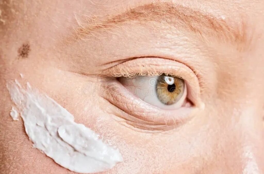 Protetor Solar Gratuito: Maceió Amplia Cuidados para Pessoas com Albinismo Imagem do artigo