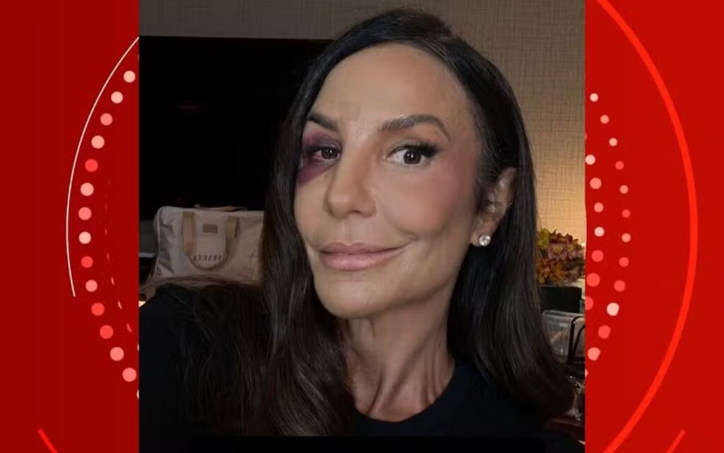 Ivete Sangalo Compartilha Recuperação Após Queda e Ganha Apoio de Celebridades Ivete Sangalo Compartilha Recuperação Após Queda e Ganha Apoio de Celebridades